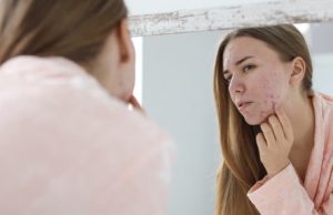 acne alert